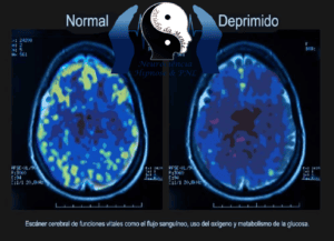 Cientistas criam marca-passo para o cérebro na luta contra a depressão -Ressonância cerebral
